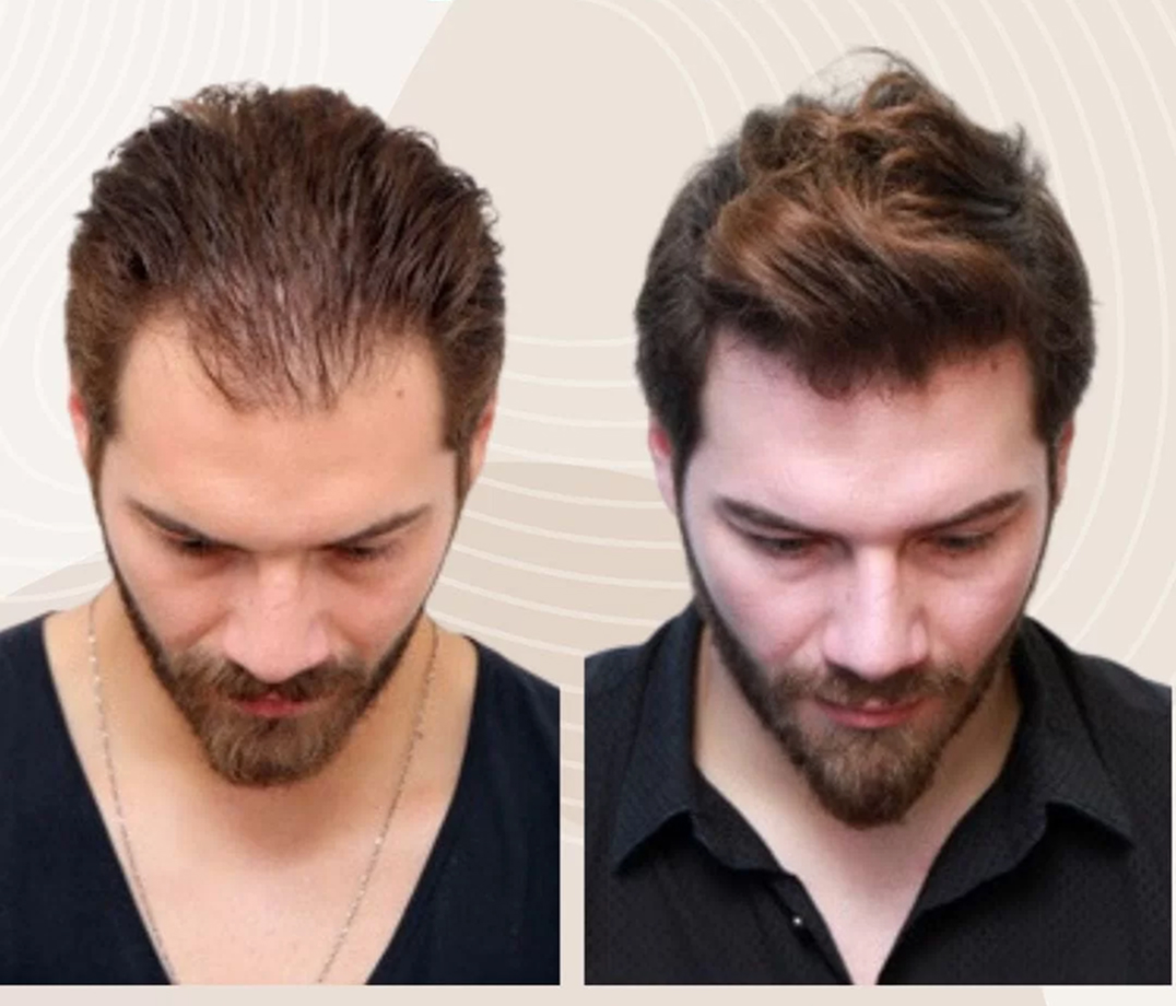 Результат пациента 1