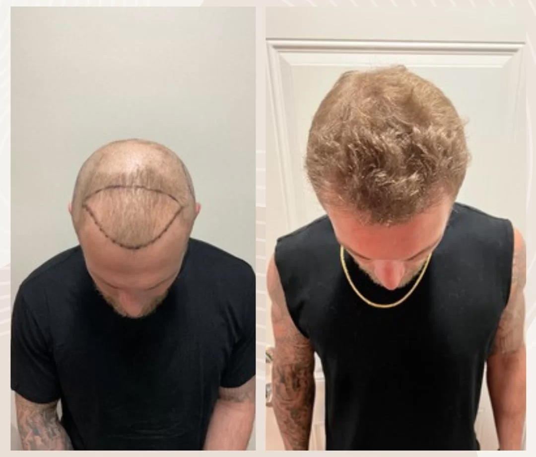 Результат пациента 2